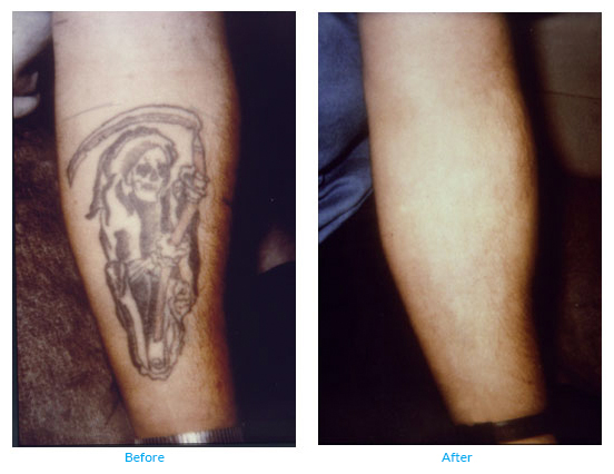Laser Tattoo Removal Before & After