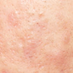 Cicatrices de acné