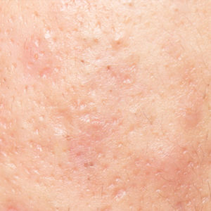 Acne scars on skin up close