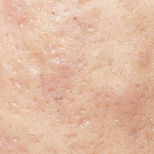 Close up of acne scars