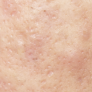 Close up of acne scars