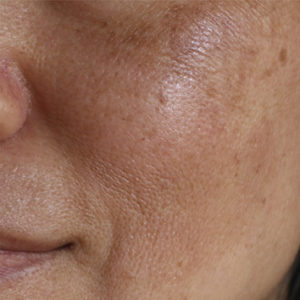 Brown aging spots on a face