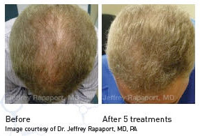 PRP for Hair Restoration Before and After Dr. Jeffrey Rapaport