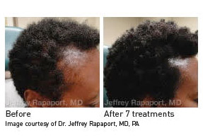 PRP for Hair Restoration Before and After Dr. Jeffrey Rapaport