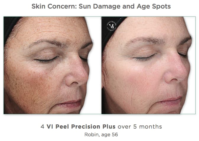 VI Peel Precision Plus Before & After