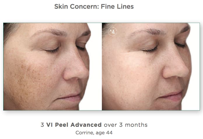 VI Peel Advanced Before & After