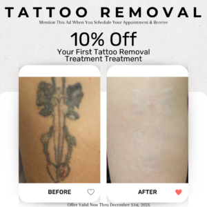 10% Off Tattoo Removal Special