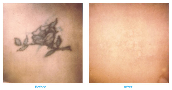 Laser Tattoo Removal can give your skin a brand new start!