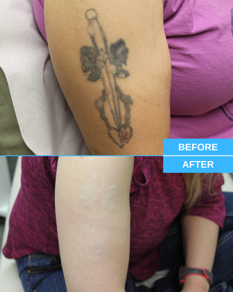 Your Laser Tattoo Removal Guide: What You Need To Know, Merrimack NH