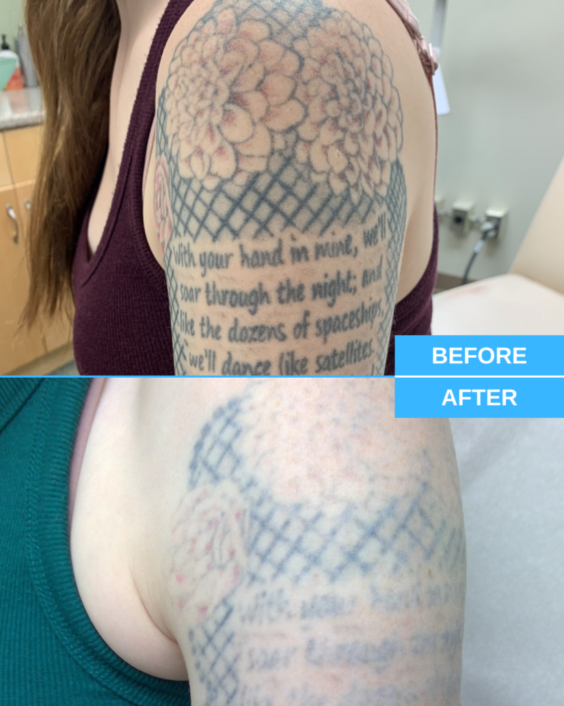 Your Laser Tattoo Removal Guide: What You Need To Know, Merrimack NH